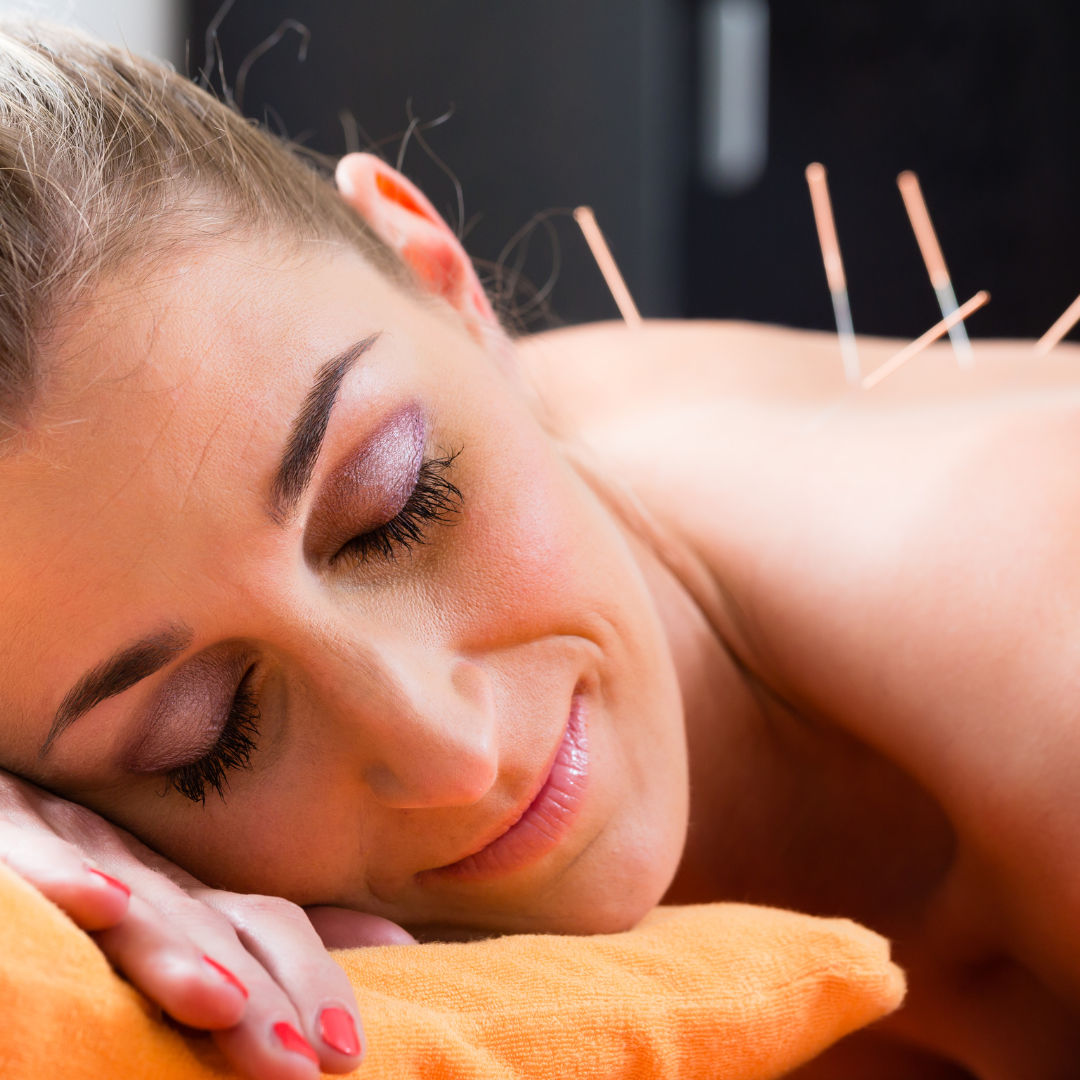 Tratamento de enxaqueca com acupuntura